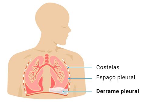 O que é o Derrame Pleural Água no Pulmão como tratar pode matar