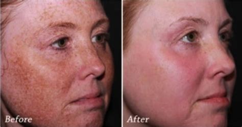 Before And After Photos Of Treatment Clarity Medspa