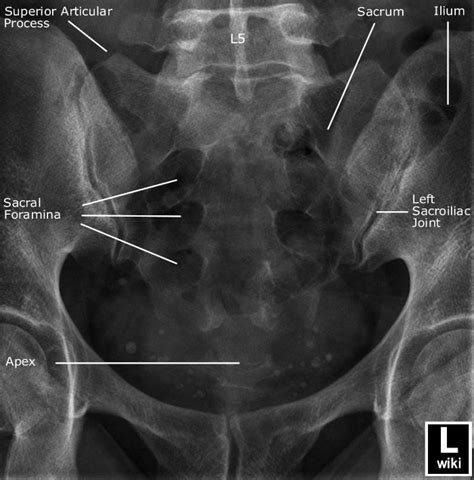 Sacrum Radiographic Anatomy Diagnostic Imaging Radiology Imaging Medical Anatomy