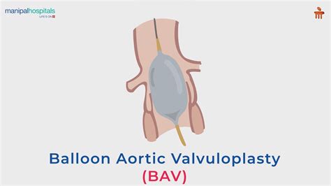 Balloon Aortic Valvuloplasty Bav Manipal Hospitals Bengaluru Youtube