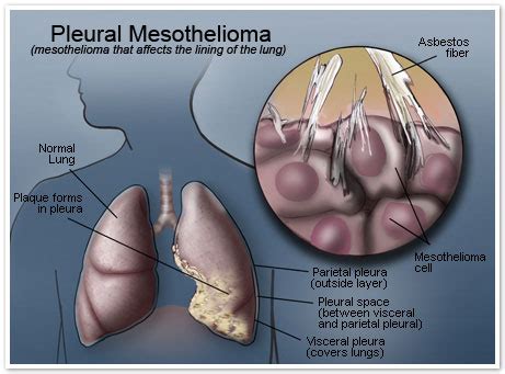 We did not find results for: mesothelioma symptoms: Mesotheliom lung cancer symptoms