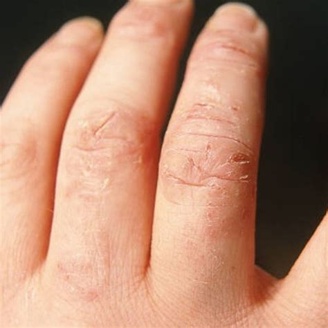 Dry Skin Hands