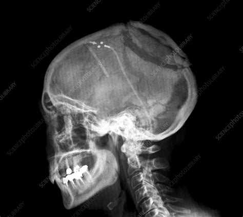 Ventricular Shunt In Brain Tumour X Ray Stock Image C0269904
