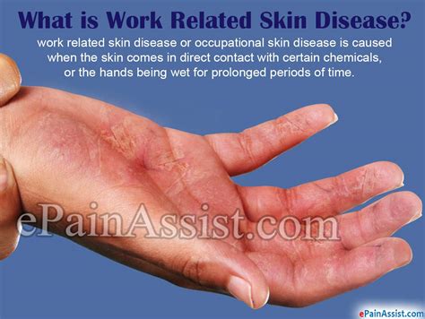 Work Related Skin Disease Or Occupational Skin Disease
