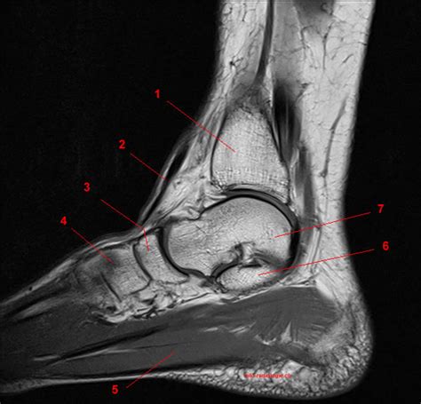 Mri patterns of neuromuscular disease involvement thigh & other muscles 2. Anatomie IRM de la cheville