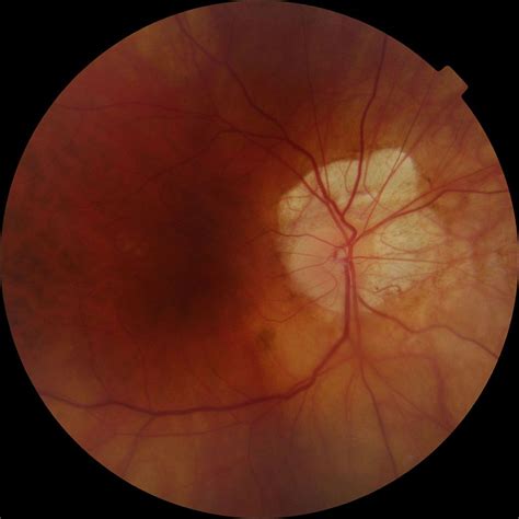 Optic Disc Tilt May Predict Glaucoma Progression In A Subset Of