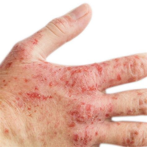 Feeling Itchy This Winter You May Have Eczema A Condition That Causes