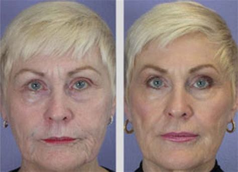 Pin On Cheek Exercises Can Firm Flabby Jowls And Cheeks