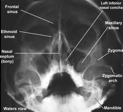 Additionally, it is also used to determine if the sinuses are clear or infected. X-ray of facial structures, Waters view: I remember those ...