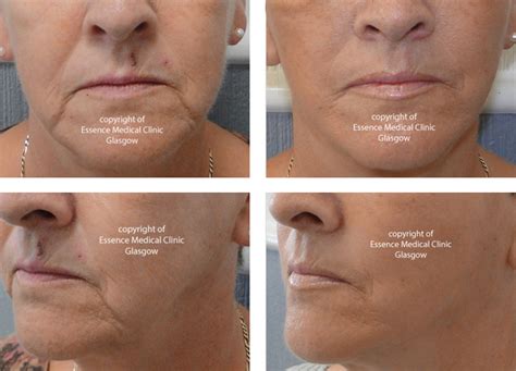 Facelift Glasgow No Cut Jowl Lift Essence Medical Cosmetic Clinic