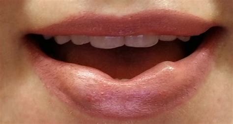 Lump In Lip Years After Filler