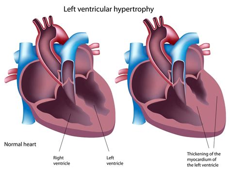 Is Steroid Induced Heart Enlargement Dangerous