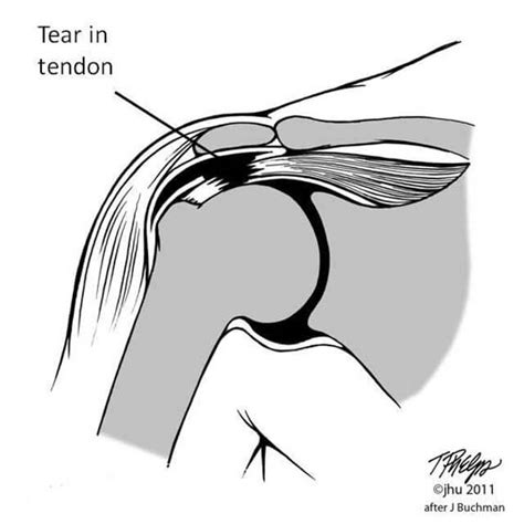 Conditions We Treat Rotator Cuff Tears Johns Hopkins Department Of