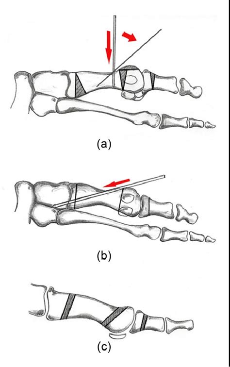 Figure 4 From Percutaneous Triple And Double Osteotomies For The