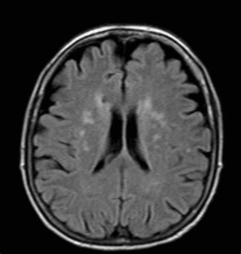 Periventricular White Matter Lesions Simple