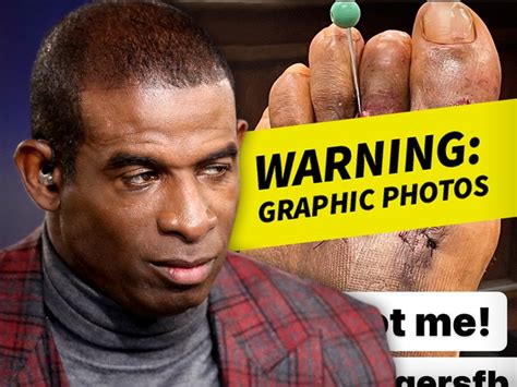 Deion Sanders Shows Bloody Surgical Wound On Foot Three Weeks Post Op