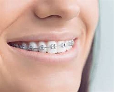 Orthodontist Braces Artofit