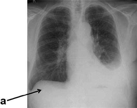 Pleural effusion is the term for fluid accumulation in the pleural space around the lungs. Chest x-ray showing a moderate left pleural effusion and ...