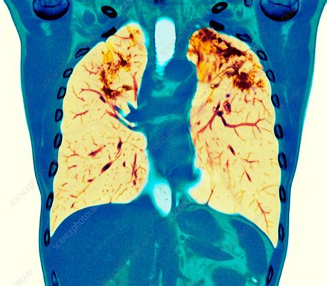 Pulmonary Sarcoidosis Ct Scan Stock Image C0372872 Science