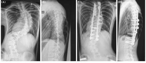 A 13 Year Old Girl With Fast Progressive Adolescent Idiopathic