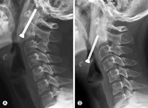 Plain X Ray Lateral Images Of The Cervical Spine Obtained 3 Months A