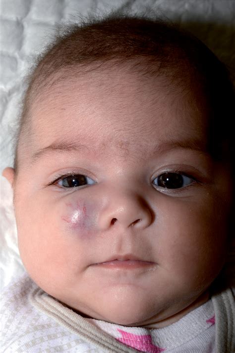 Figure 3 From Changing Treatment Decisions For Infantile Hemangioma