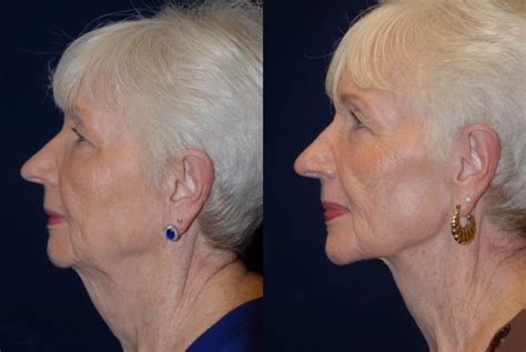 Direct Neck Lift Tower Cosmetic Surgery