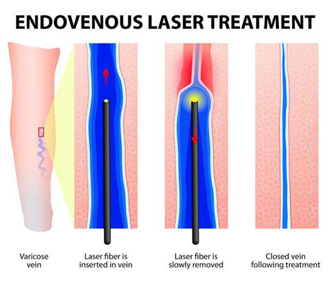 Endovenous Laser Treatment Chicago Vein And Vascular Center