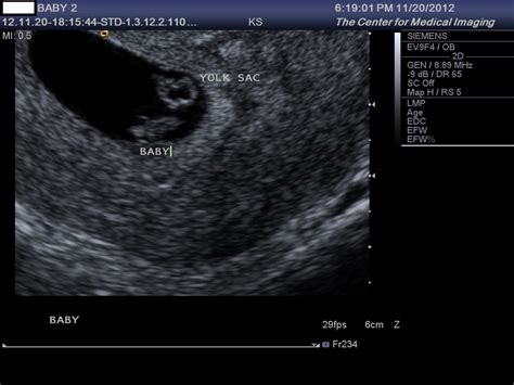 On transvaginal ultrasound, a gestational sac is identified at 5 weeks. My Pregnancy Journal...birth & beyond: 7 weeks, 4 days ...