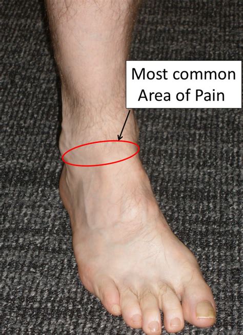 Pain On Top Outer Side Of Foot Pain In Arch Of Foot Foot Pain In