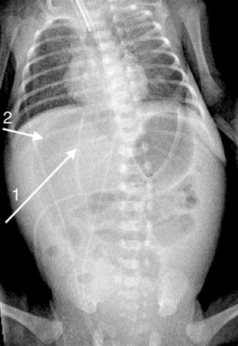 How To Use Abdominal X Rays In Preterm Infants Suspected Of Developing
