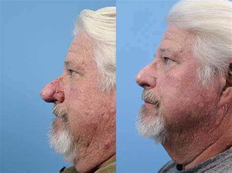 Rhinophyma Before And After Pictures Case 147 West Des Moines And Ames
