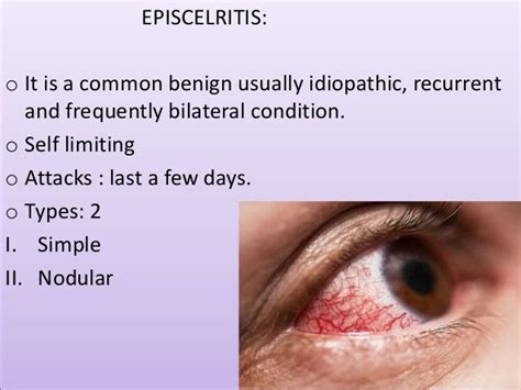 Episcleritis And Scleritis Ophthalmology