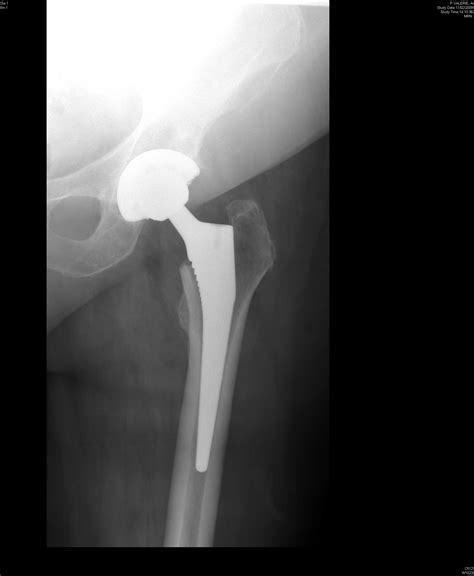 Complications Of Total Hip Replacement Surgerytotal Hip Arthroplasty