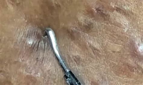 Nauseating Video Shows Ingrown Hairs Being Squeezed From A Woman S Free Hot Nude Porn Pic Gallery