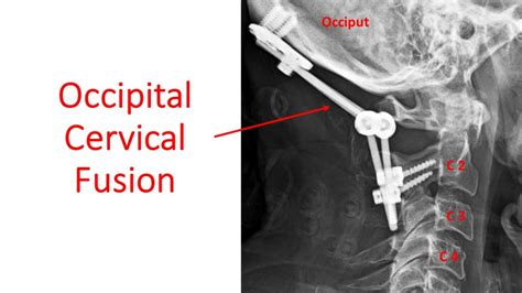 Occipital Cervical Fusion Centeno Schultz Clinic