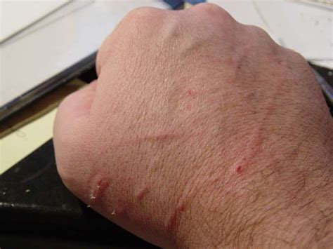 Cat Scratch Disease Pictures Symptoms Treatment Diagnosis