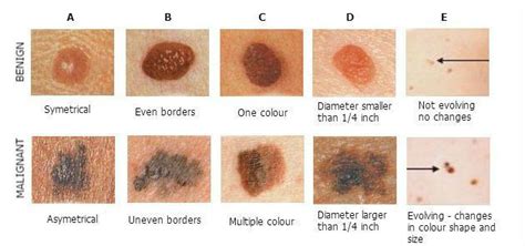 Pin On Skin Moles