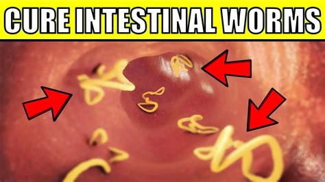 8 Natural Ways To Get Rid Of Intestinal Worms Epic Natural Health