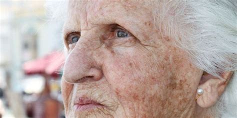 Skin Conditions Common In Older Adults Consumer Health News Healthday