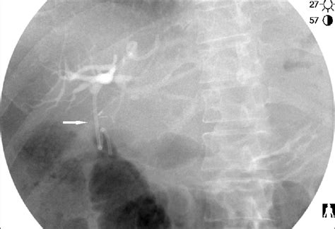 Ercp View Of The Biliary Stent In The Fistula Connecting The Deep Left
