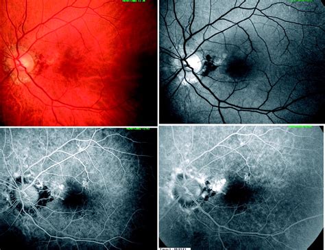 Angioid Streaks In Identical Twins British Journal Of Ophthalmology