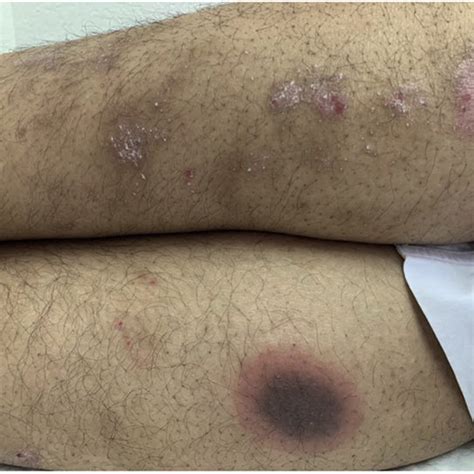 Multiple Erythematous Scaly Plaques On Left Calf Representing