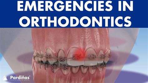 How To Fix Broken Braces And Other Orthodontic Emergencies Poking Wire