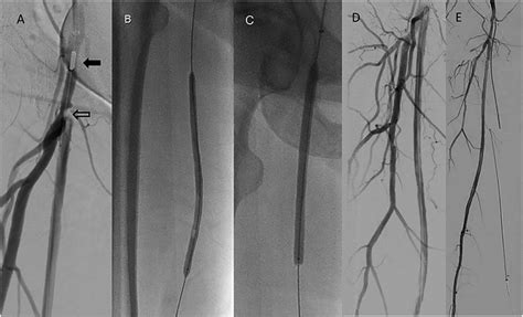 Angiographic Images Demonstrate The Atherectomy Balloon Angioplasty