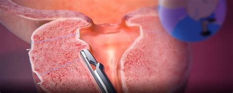 Urolift An Effective Minimally Invasive Treatment For Urinary Obstruction Caused By An Enlarged