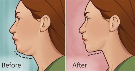 Double chin dikenal sebagai penumpukan lemak berlebih di bawah dagu atau di sekitar leher. CARA NAK HAPUSKAN DOUBLE CHIN A.K.A DAGU BERLAPIS DENGAN ...