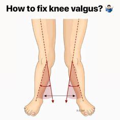 There remains a wide gap between knees when a bow legged person keeps his feet together. 10 ideas de Genu Valgo | genu valgo, ejercicios ...