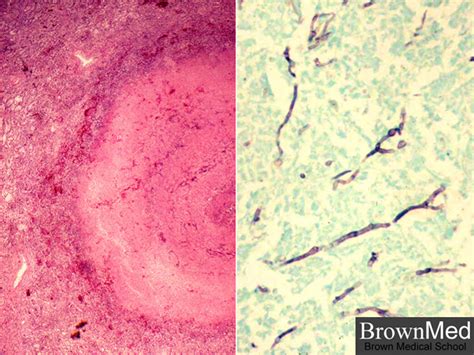 Aspergillosis