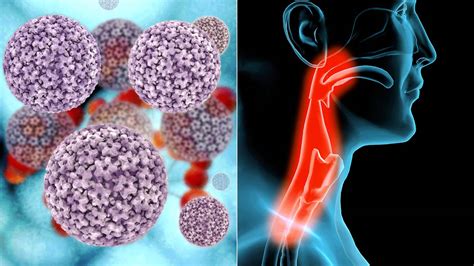 5 Things To Know About Hpv Related Throat Cancer